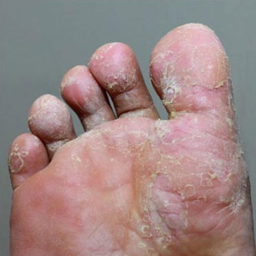 Athlete’s Foot