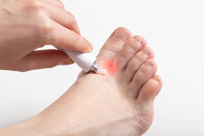 Managing Athlete’s Foot Effectively