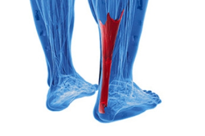 What You Need to Know About Achilles Tendon Injuries