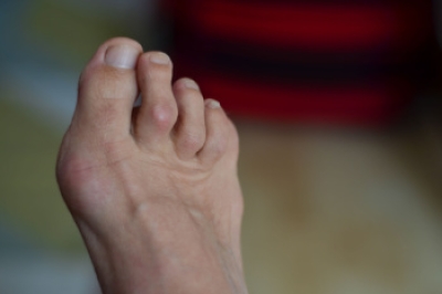 Symptoms and Causes of Hammertoe