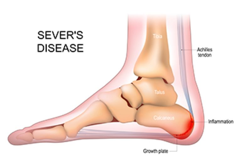 Heel Pain From Sever’s Disease