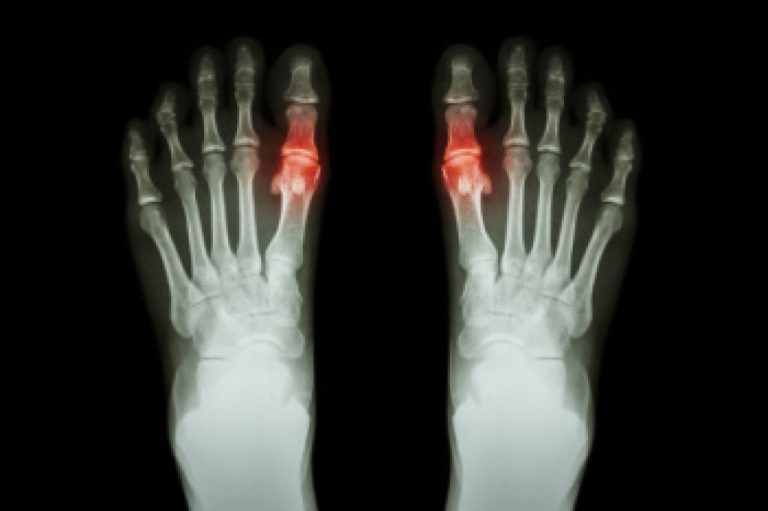 What Can Cause Gout?